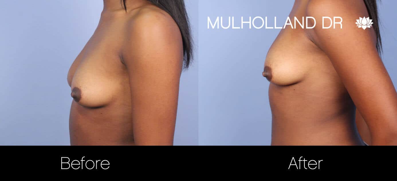 Fat Transfer Breast Augmentation - Before and After Gallery - Patient Photo 27