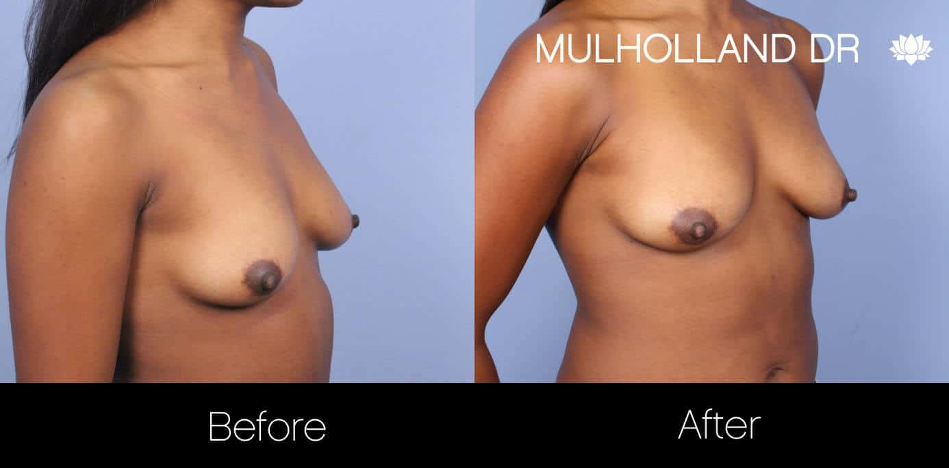 Fat Transfer Breast Augmentation - Before and After Gallery - Patient Photo 28