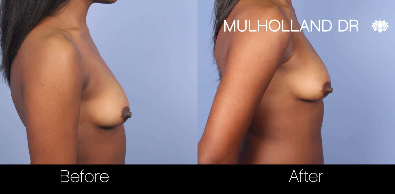 Fat Transfer Breast Augmentation - Before and After Gallery - Patient Photo 29