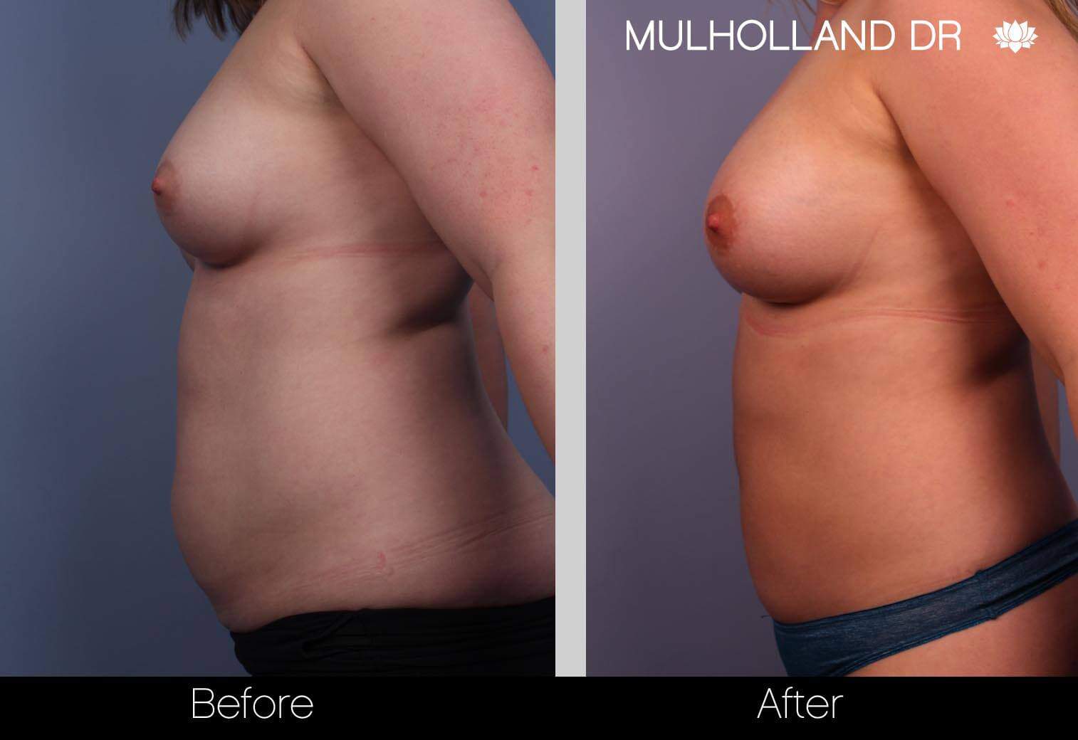 Fat Transfer Breast Augmentation - Before and After Gallery - Patient Photo 3