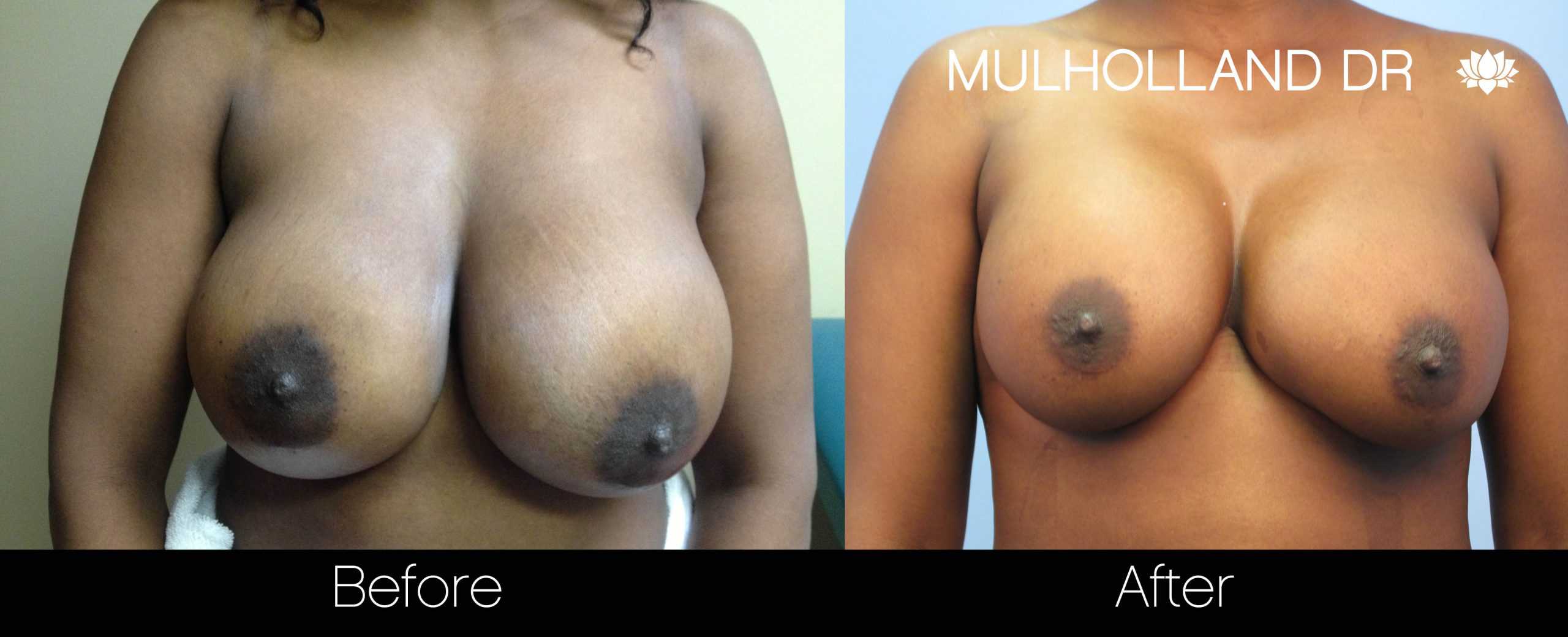 Fat Transfer Breast Augmentation - Before and After Gallery - Patient Photo 30