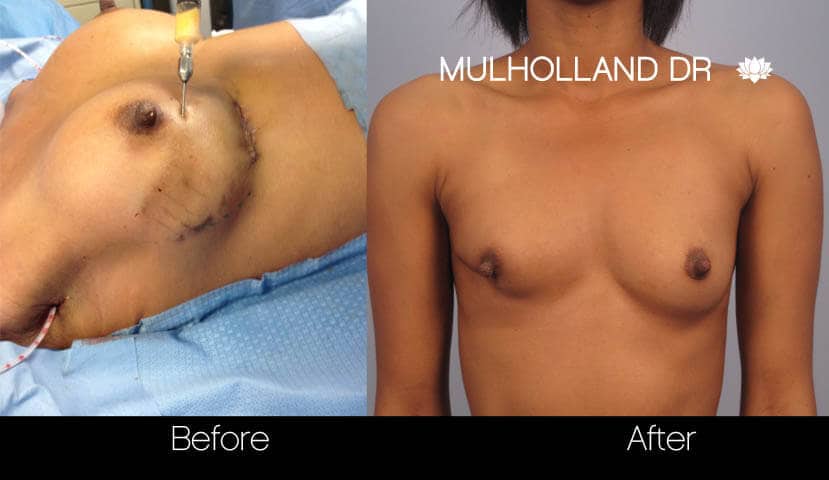 Fat Transfer Breast Augmentation - Before and After Gallery - Patient Photo 31