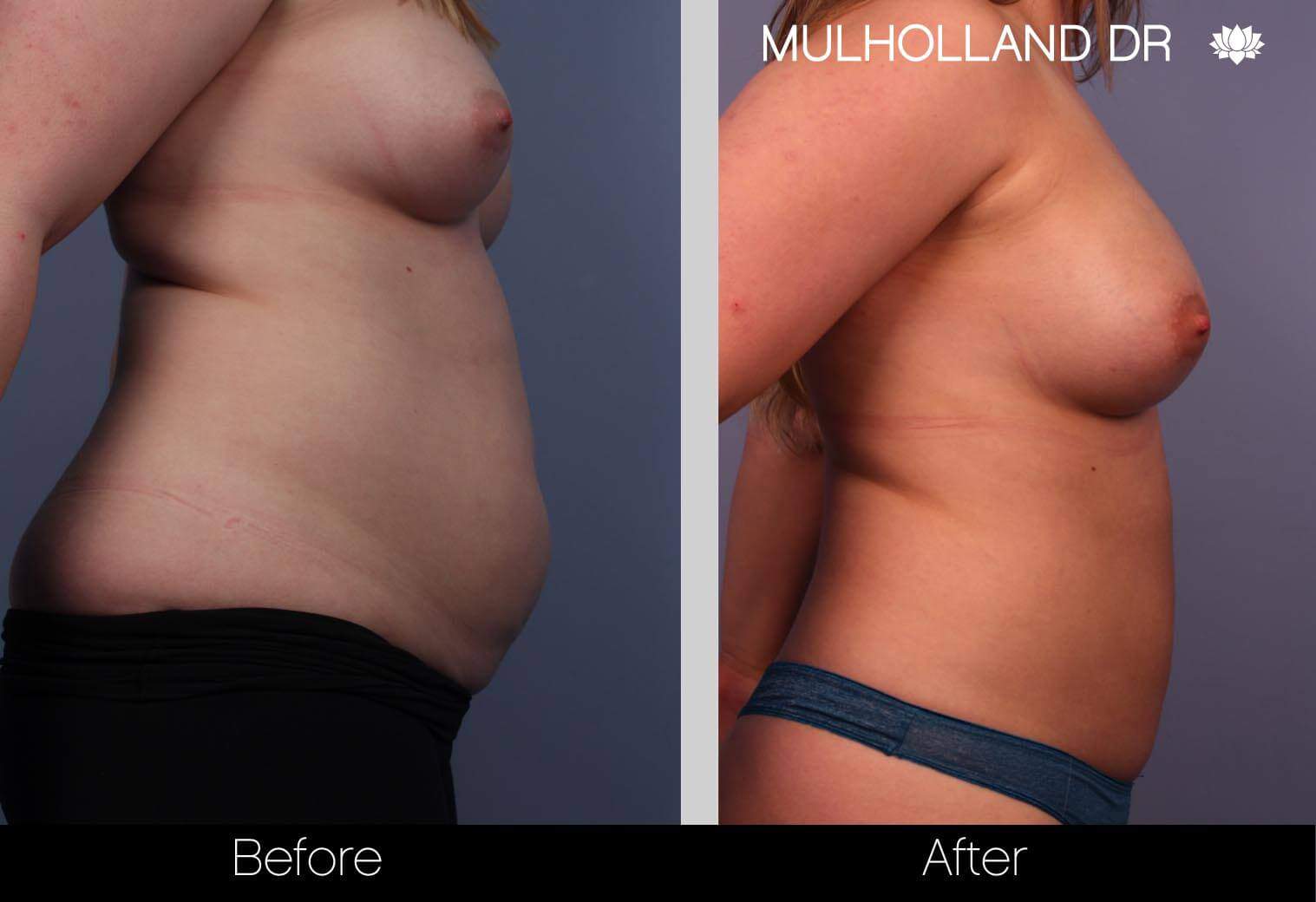 Fat Transfer Breast Augmentation - Before and After Gallery - Patient Photo 5