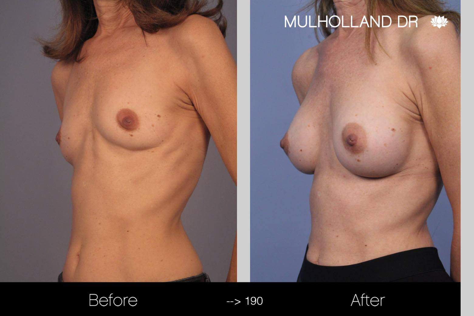 Fat Transfer Breast Augmentation - Before and After Gallery - Patient Photo 7