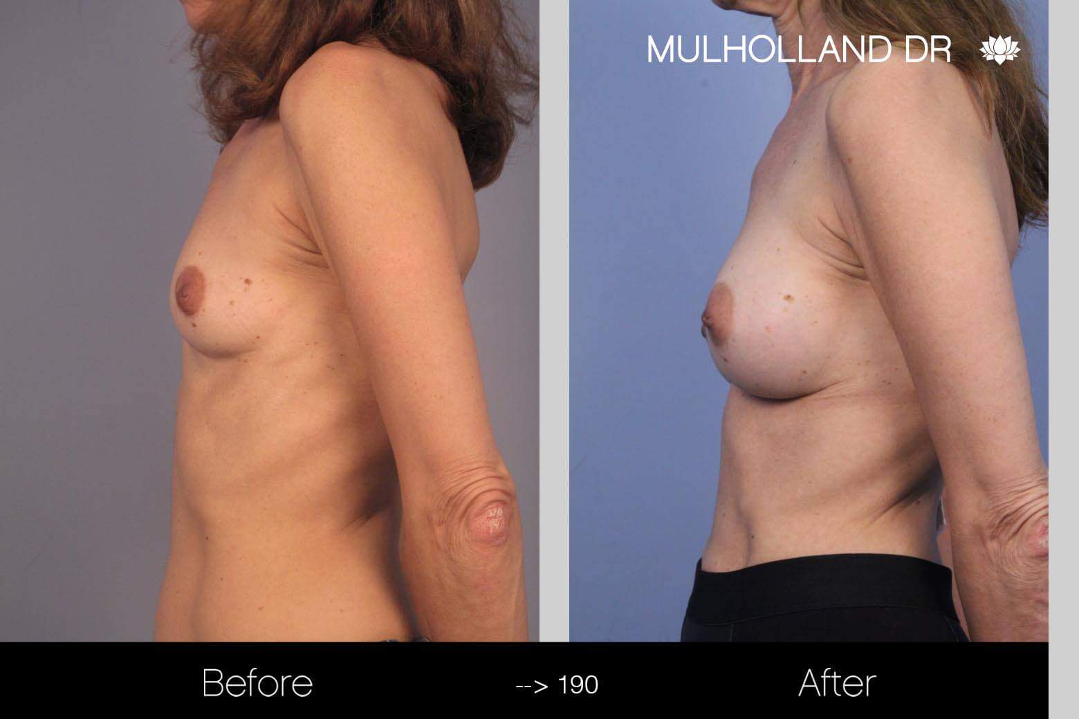 Fat Transfer Breast Augmentation - Before and After Gallery - Patient Photo 8