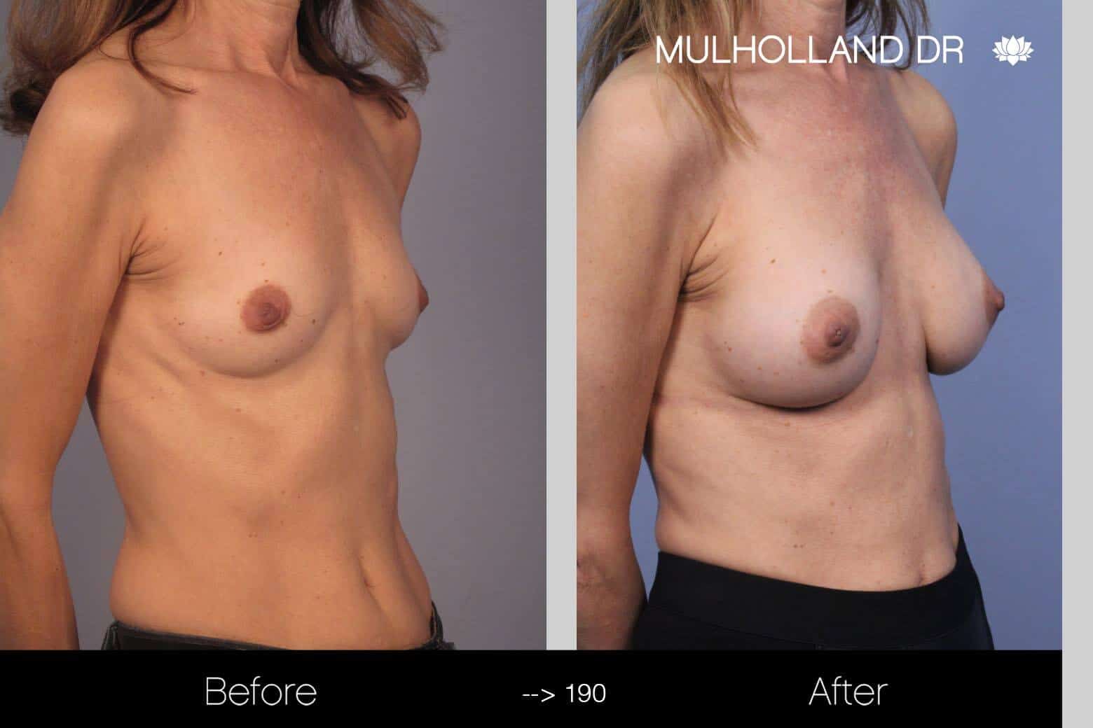 Fat Transfer Breast Augmentation - Before and After Gallery - Patient Photo 9