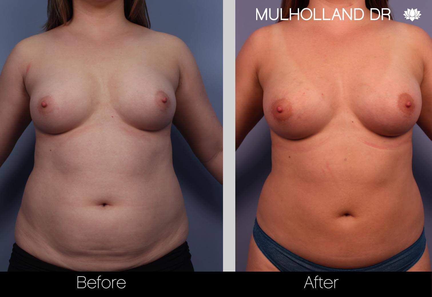 Fat Transfer Breast Augmentation - Before and After Gallery - Patient Photo
