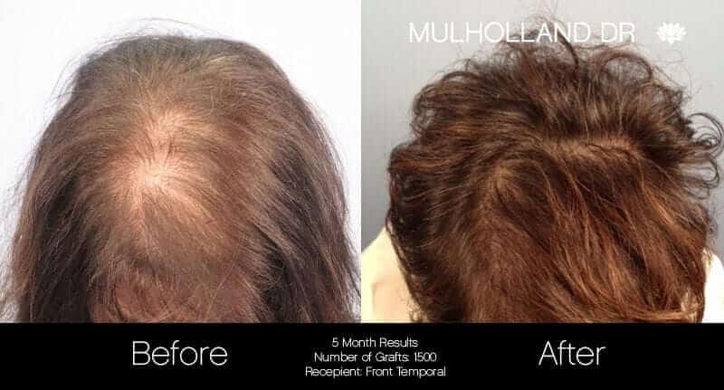 Female Hair Transplant - Before and After Gallery - Patient Photo 1