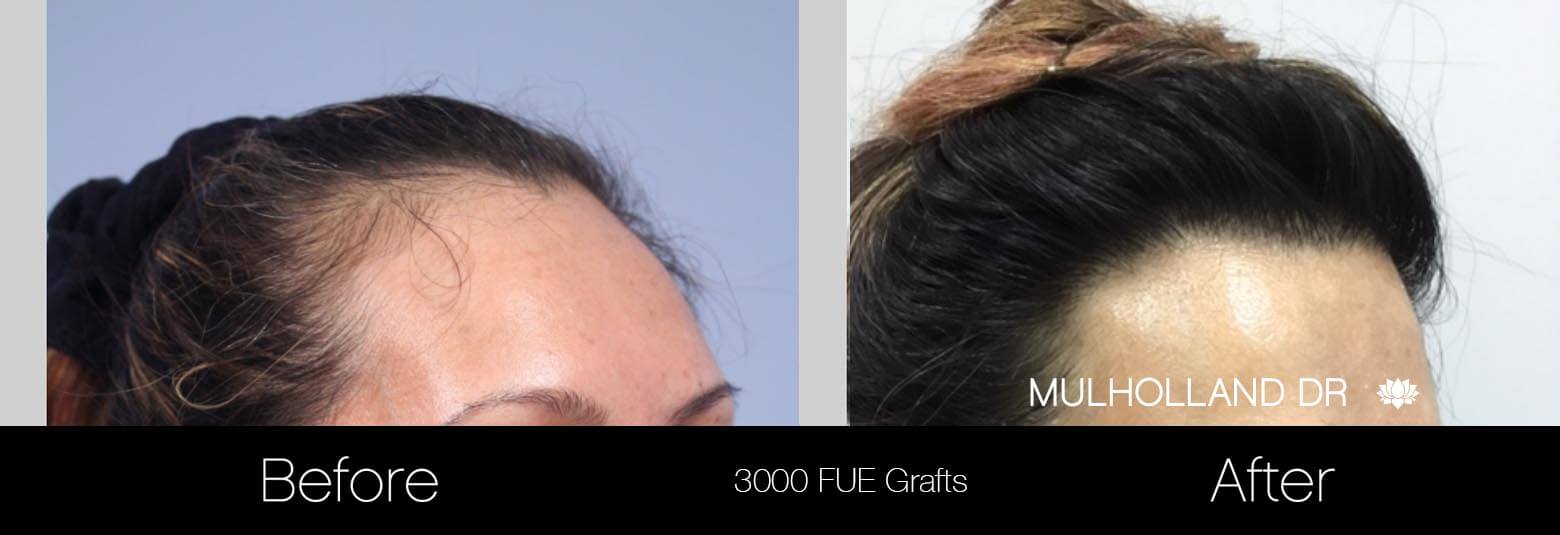 Female Hair Transplant - Before and After Gallery - Patient Photo 2