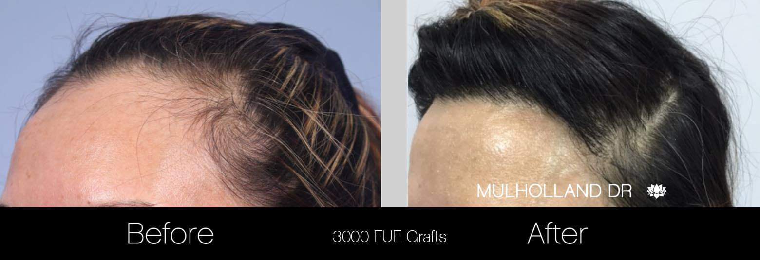 Female Hair Transplant - Before and After Gallery - Patient Photo 3