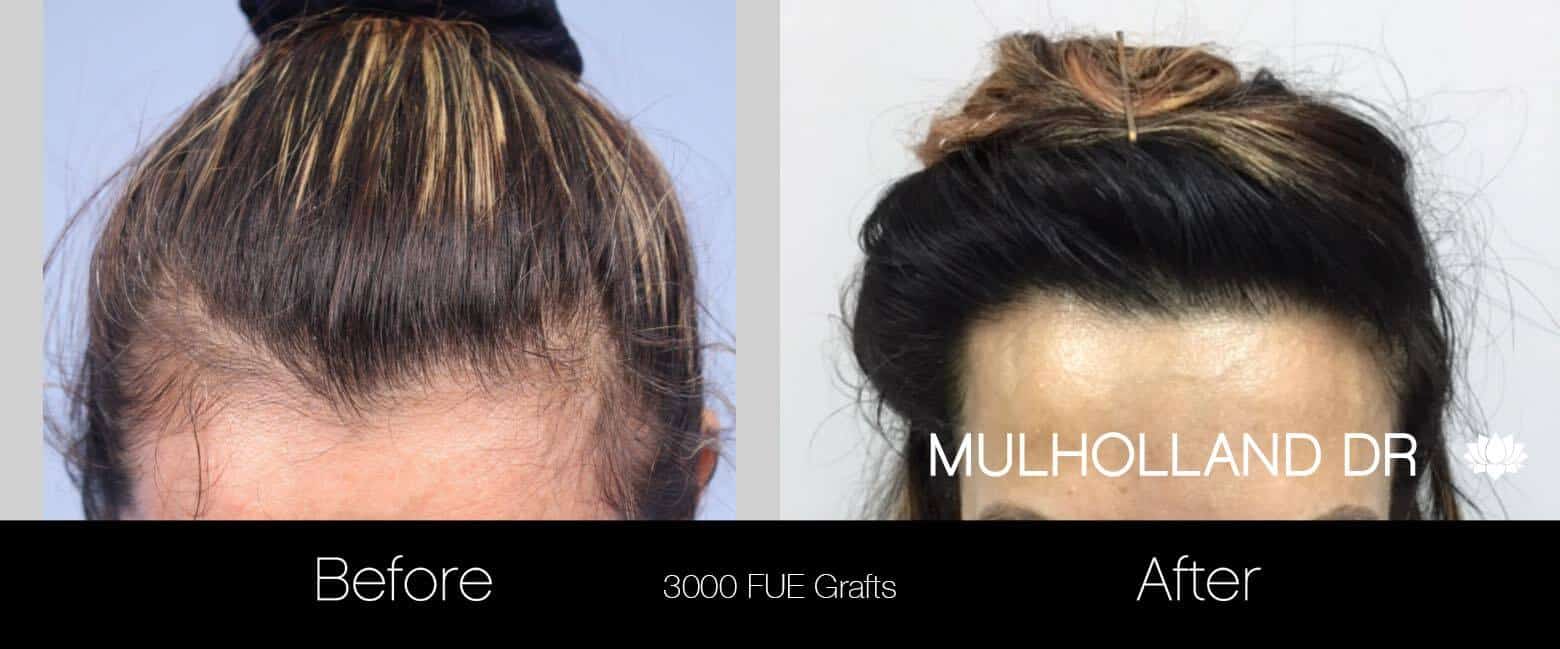 Female Hair Transplant - Before and After Gallery - Patient Photo 4