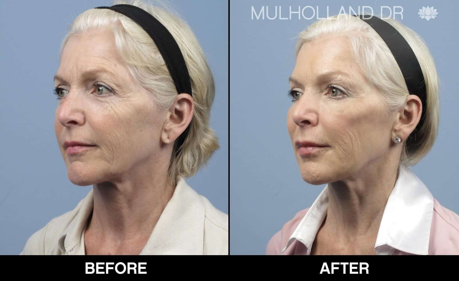 Fractional CO2 - Before and After Gallery - Patient Photo 15
