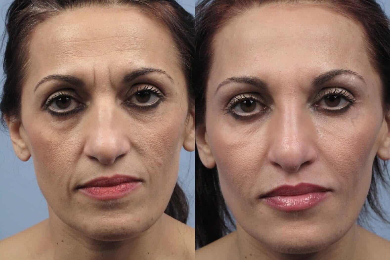 Fractional CO2 - Before and After Gallery - Patient Photo 18