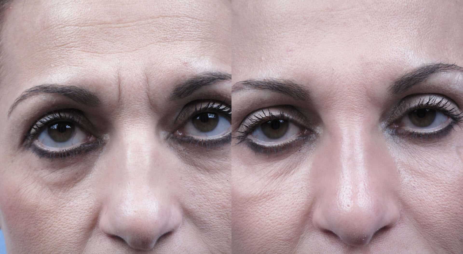 Fractional CO2 - Before and After Gallery - Patient Photo 19