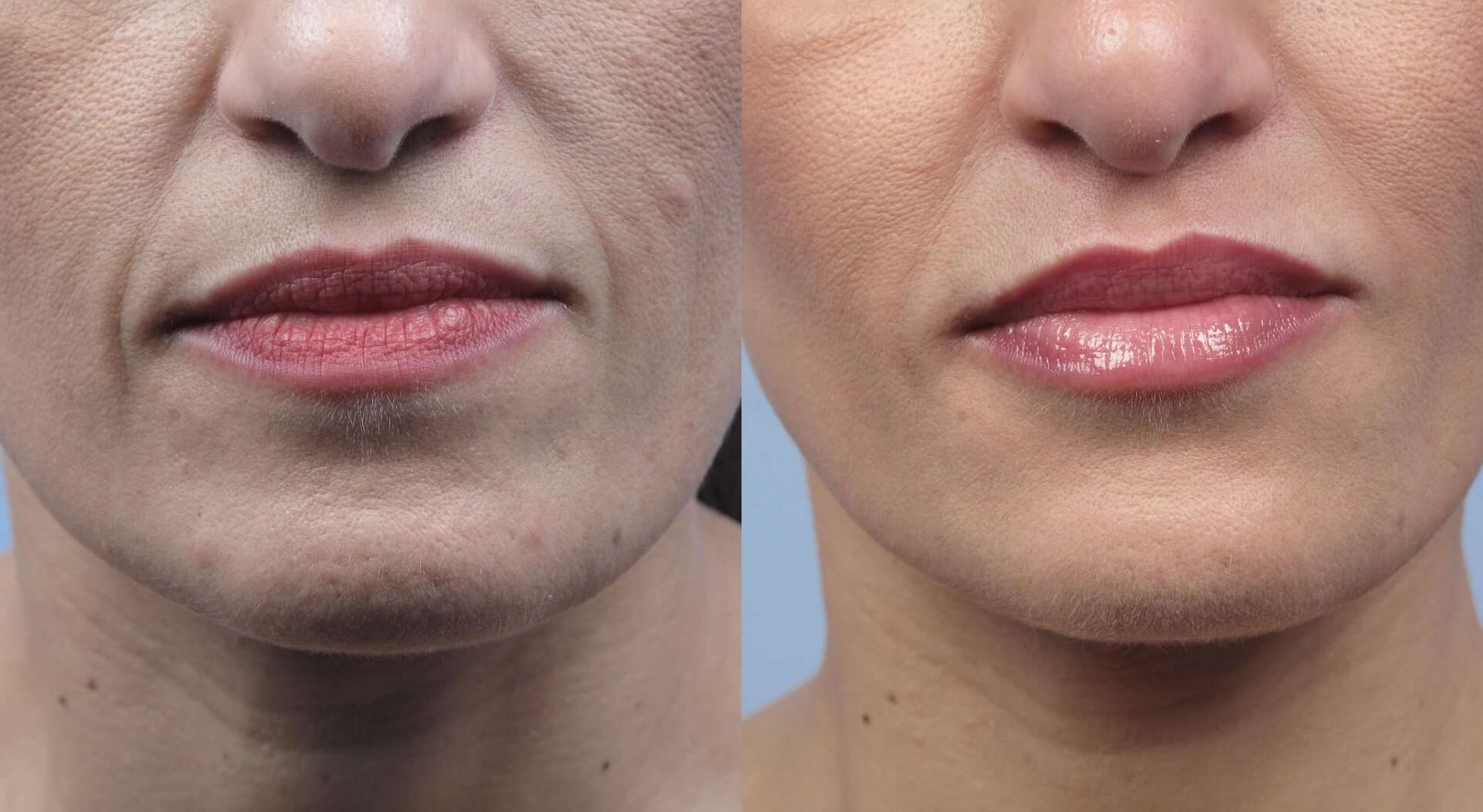 Fractional CO2 - Before and After Gallery - Patient Photo 20