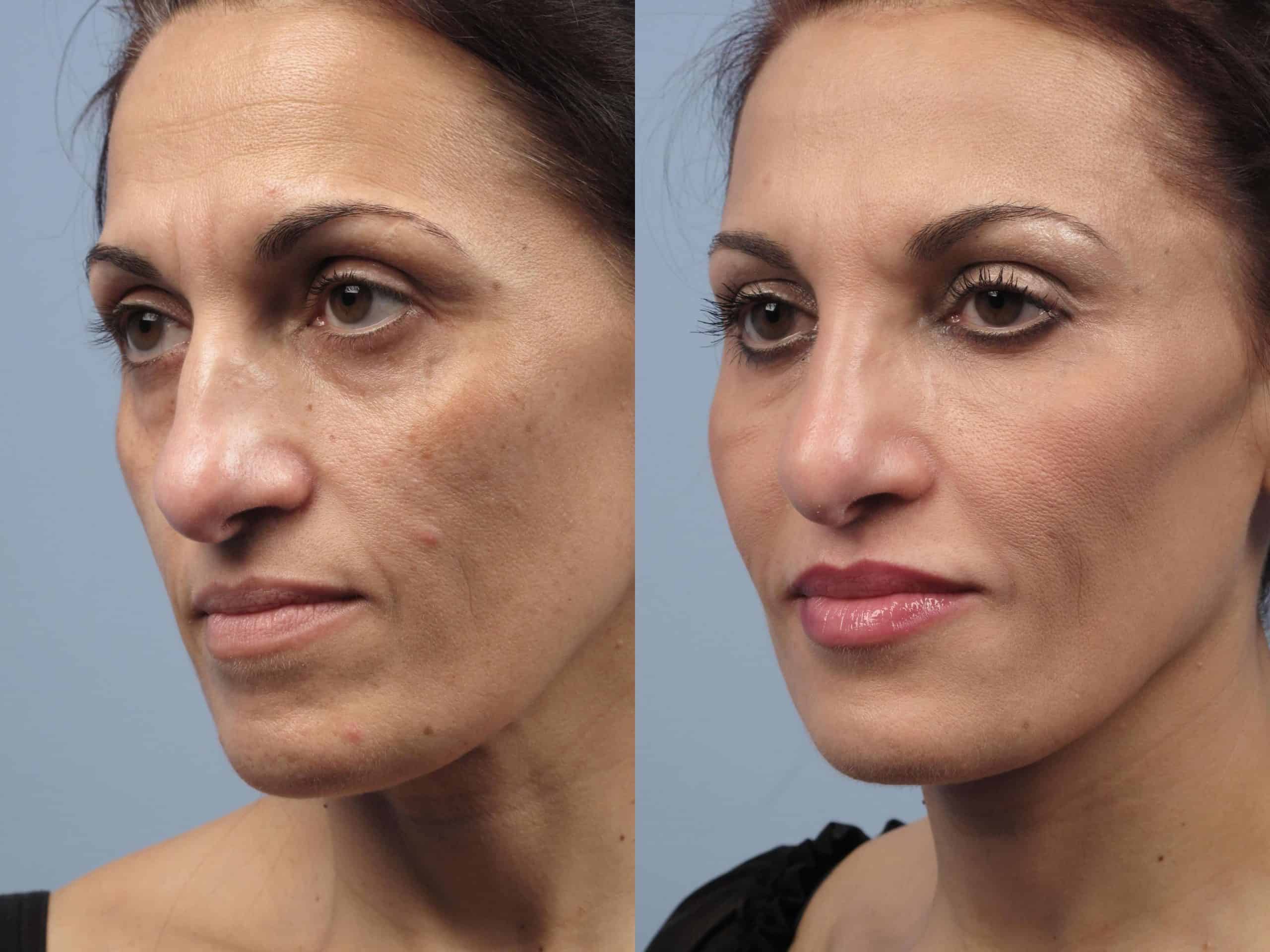 Fractional CO2 - Before and After Gallery - Patient Photo 21