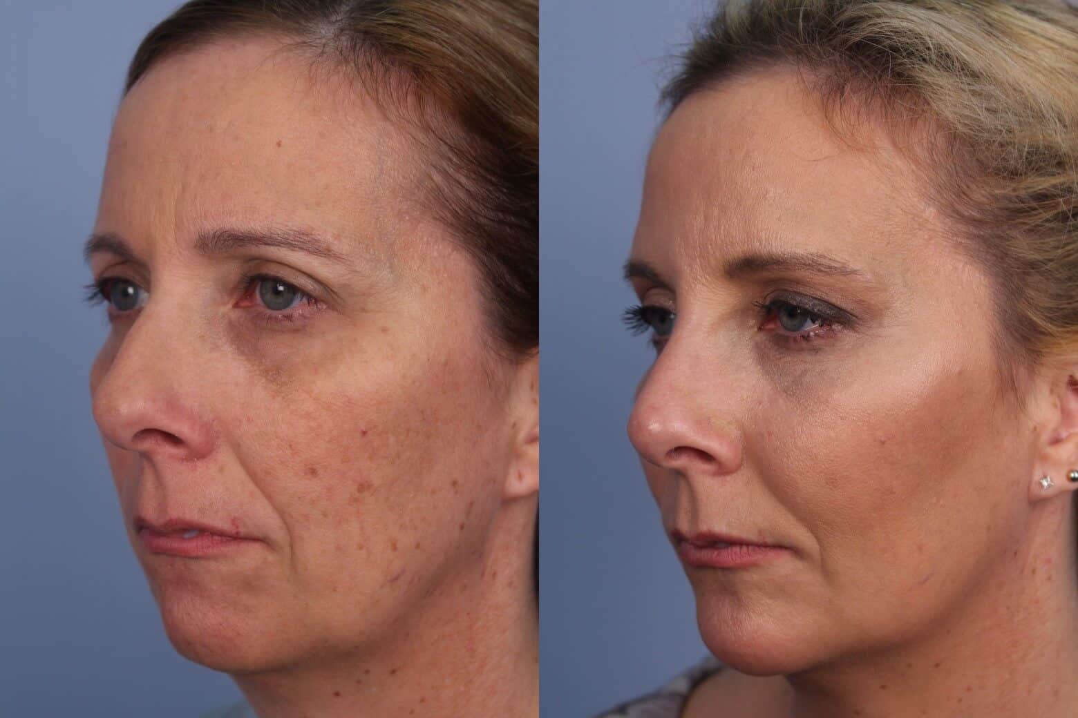 Fractional CO2 - Before and After Gallery - Patient Photo 34
