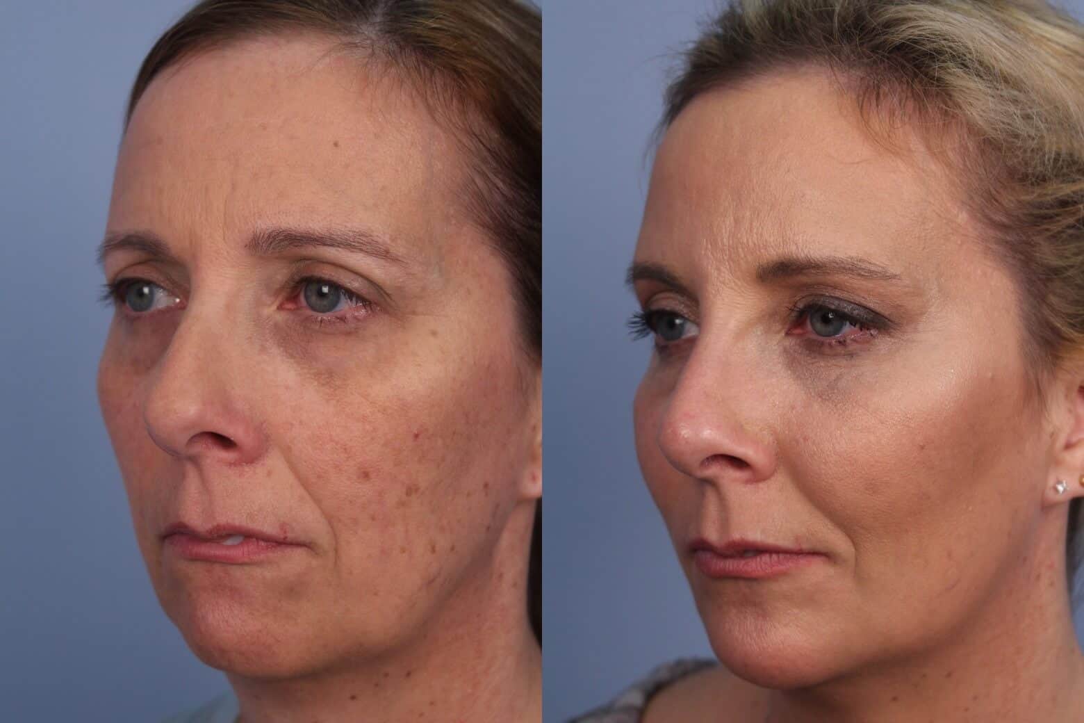 Fractional CO2 - Before and After Gallery - Patient Photo 36