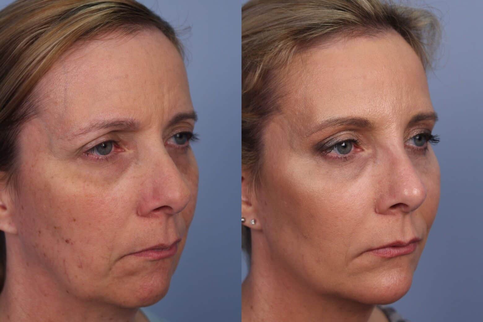 Fractional CO2 - Before and After Gallery - Patient Photo 38