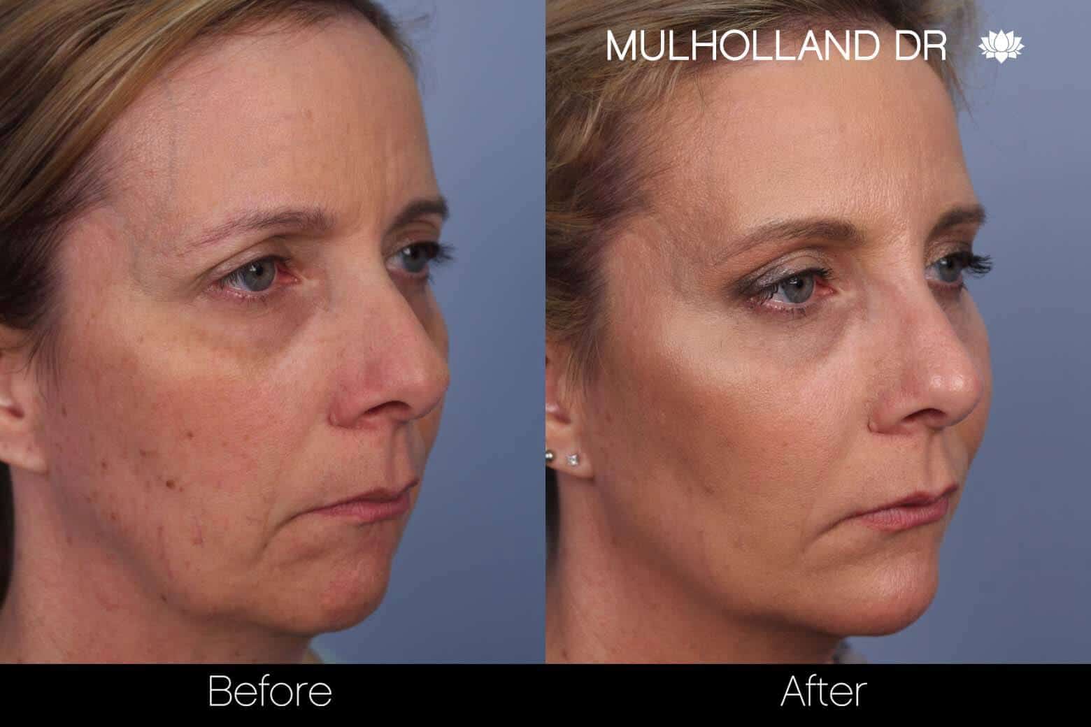 Fractional CO2 - Before and After Gallery - Patient Photo 39