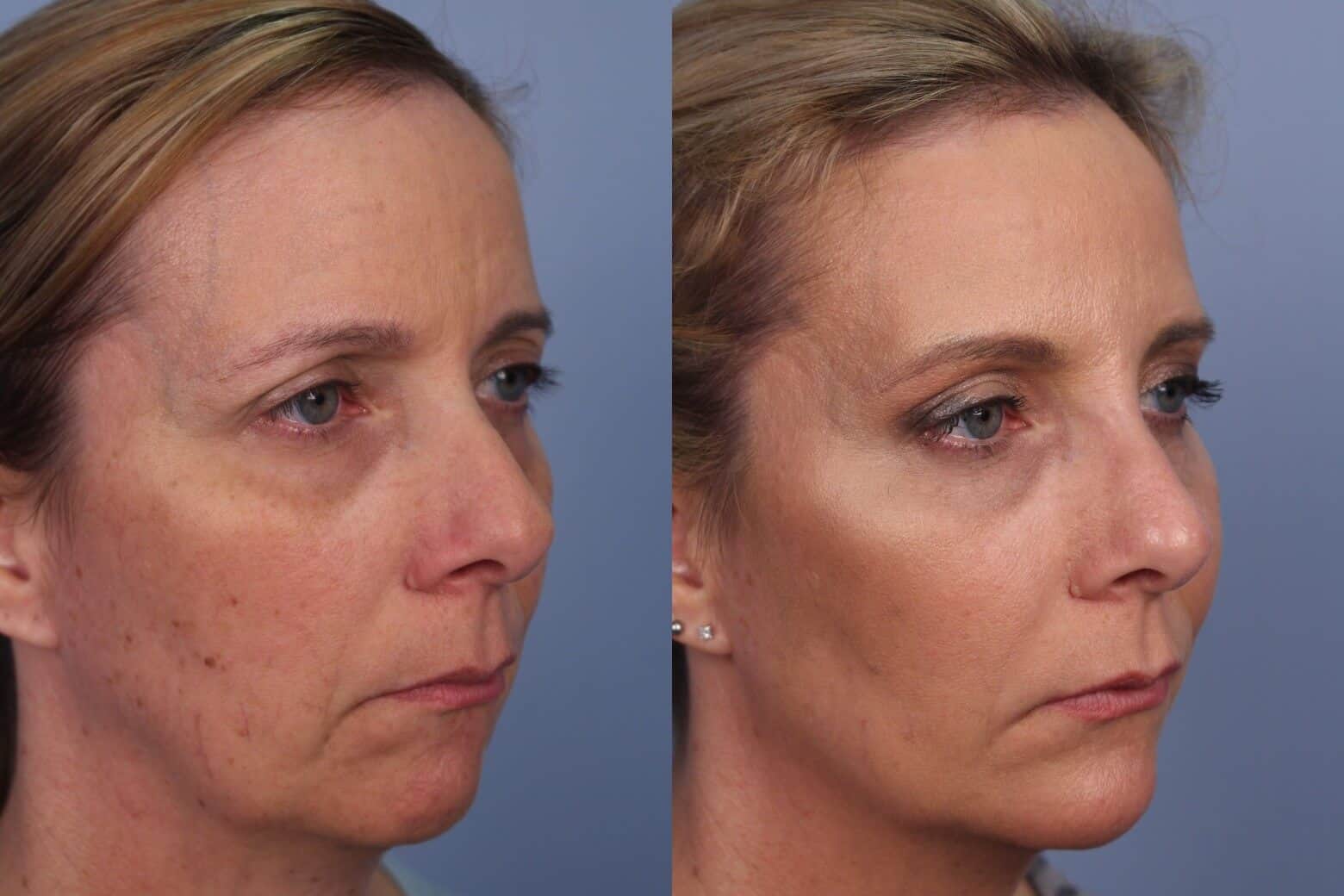 Fractional CO2 - Before and After Gallery - Patient Photo 40