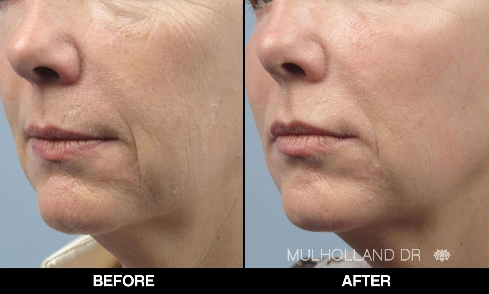 Fractional CO2 - Before and After Gallery - Patient Photo 53