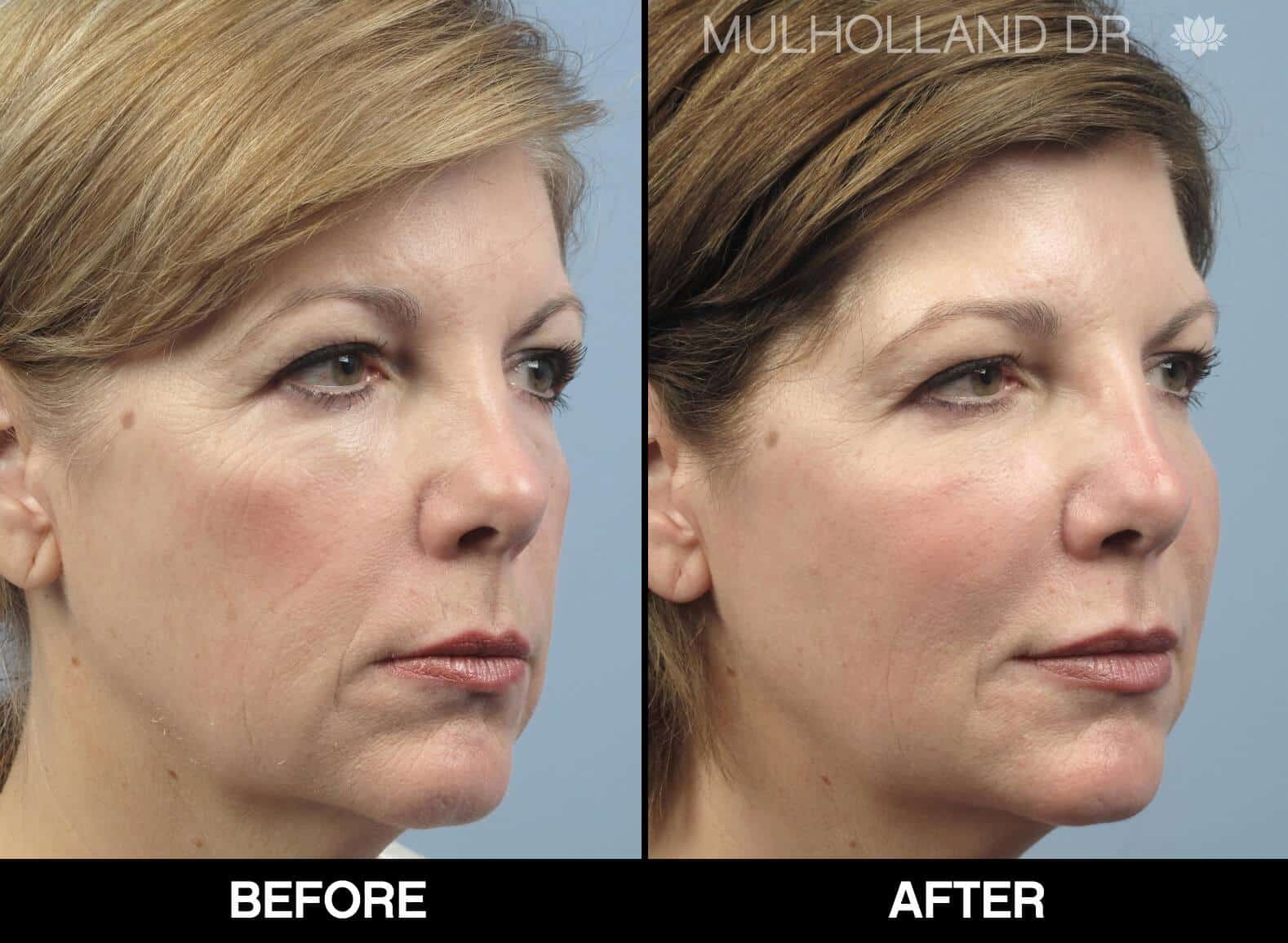 Fractional CO2 - Before and After Gallery - Patient Photo 60