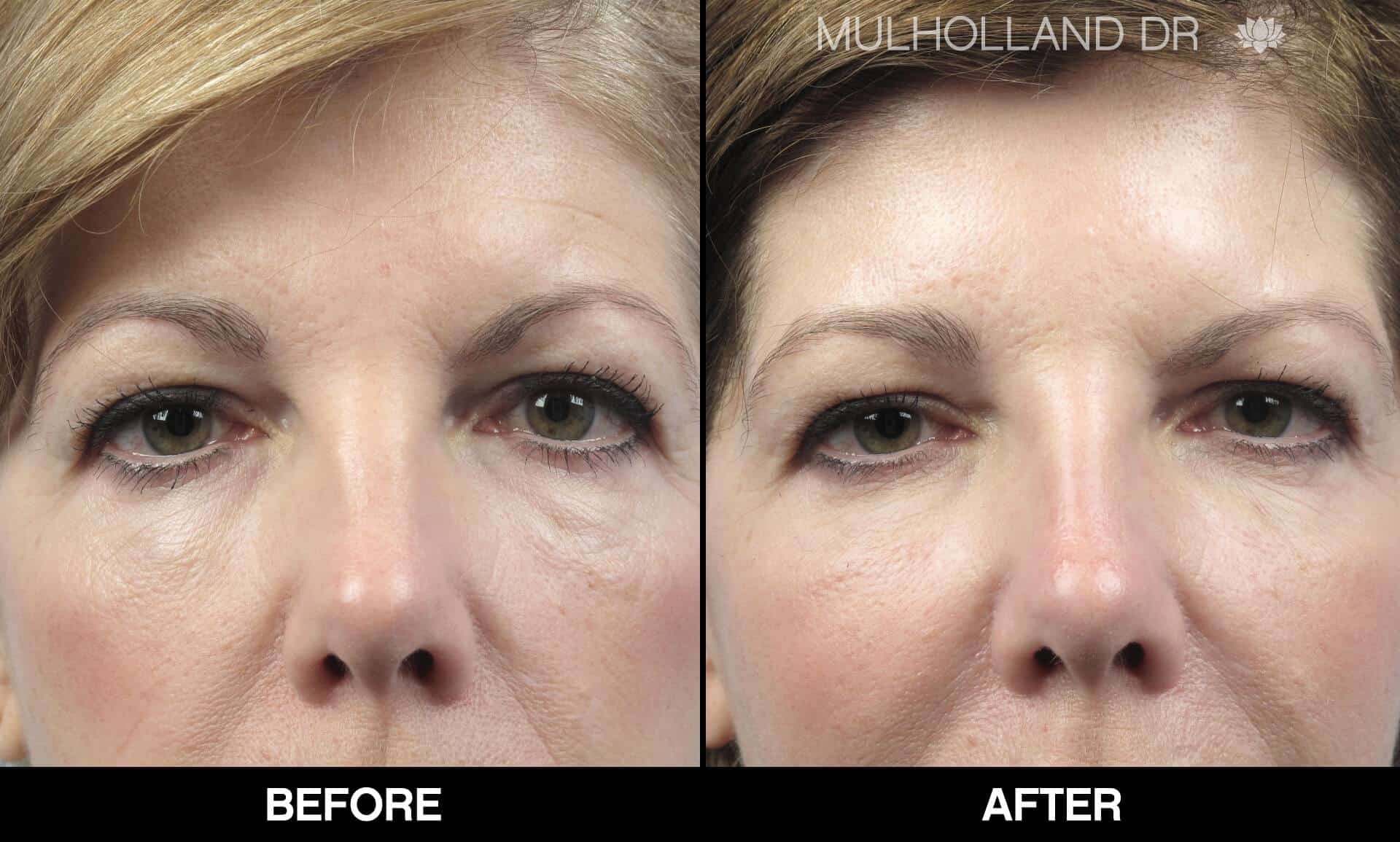 Fractional CO2 - Before and After Gallery - Patient Photo 61