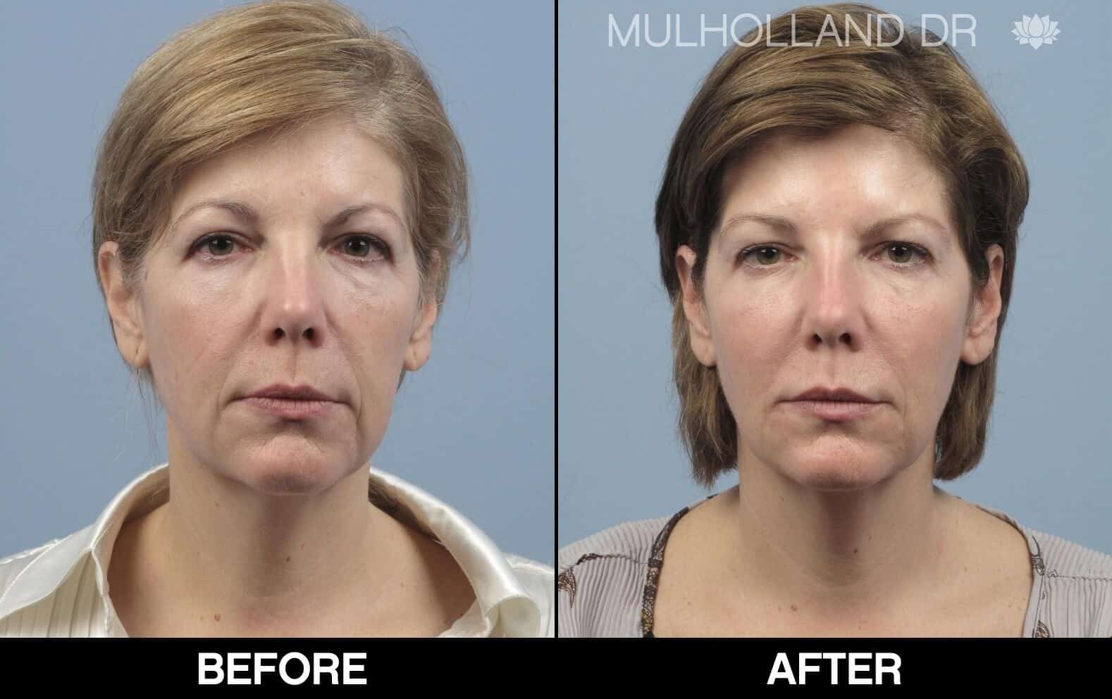 Fractional CO2 - Before and After Gallery - Patient Photo 62
