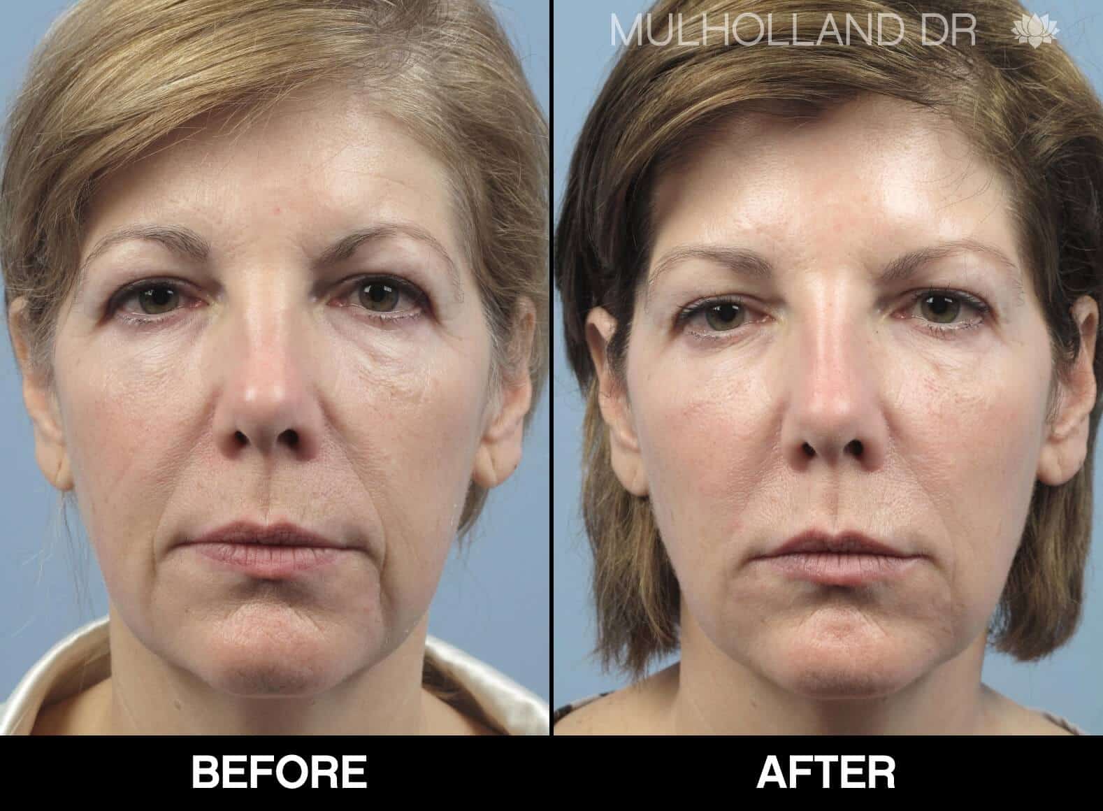 Fractional CO2 - Before and After Gallery - Patient Photo 63