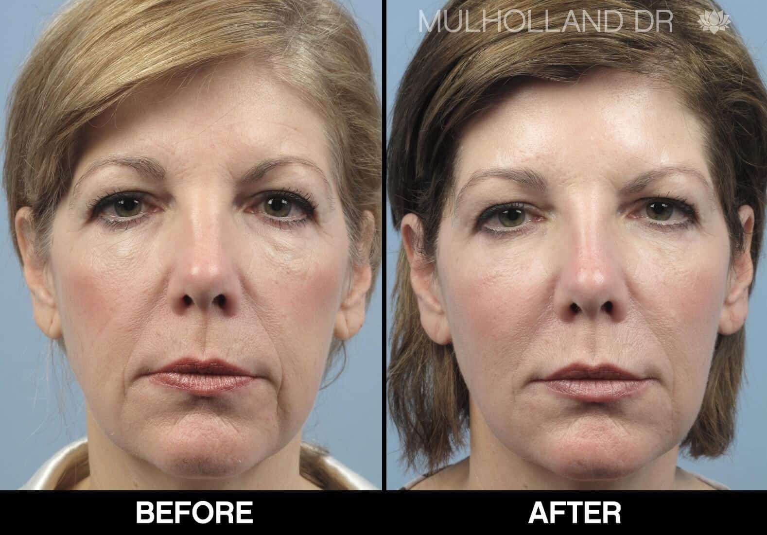 Fractional CO2 - Before and After Gallery - Patient Photo 64