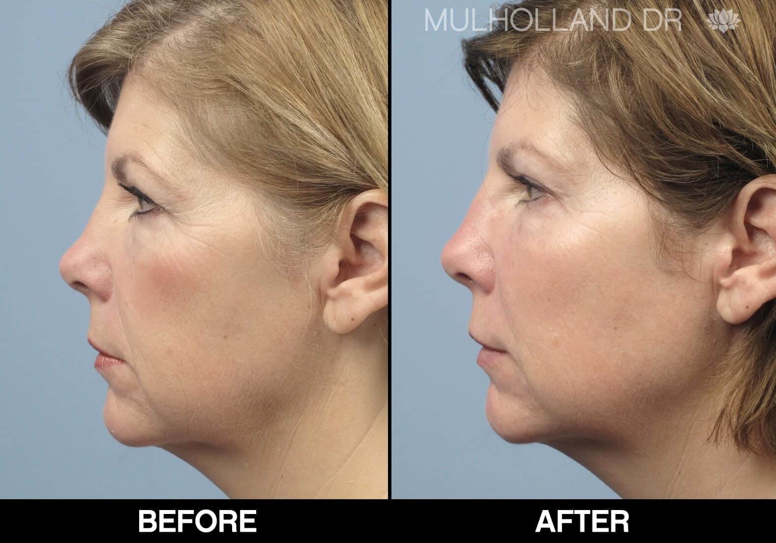 Fractional CO2 - Before and After Gallery - Patient Photo 66