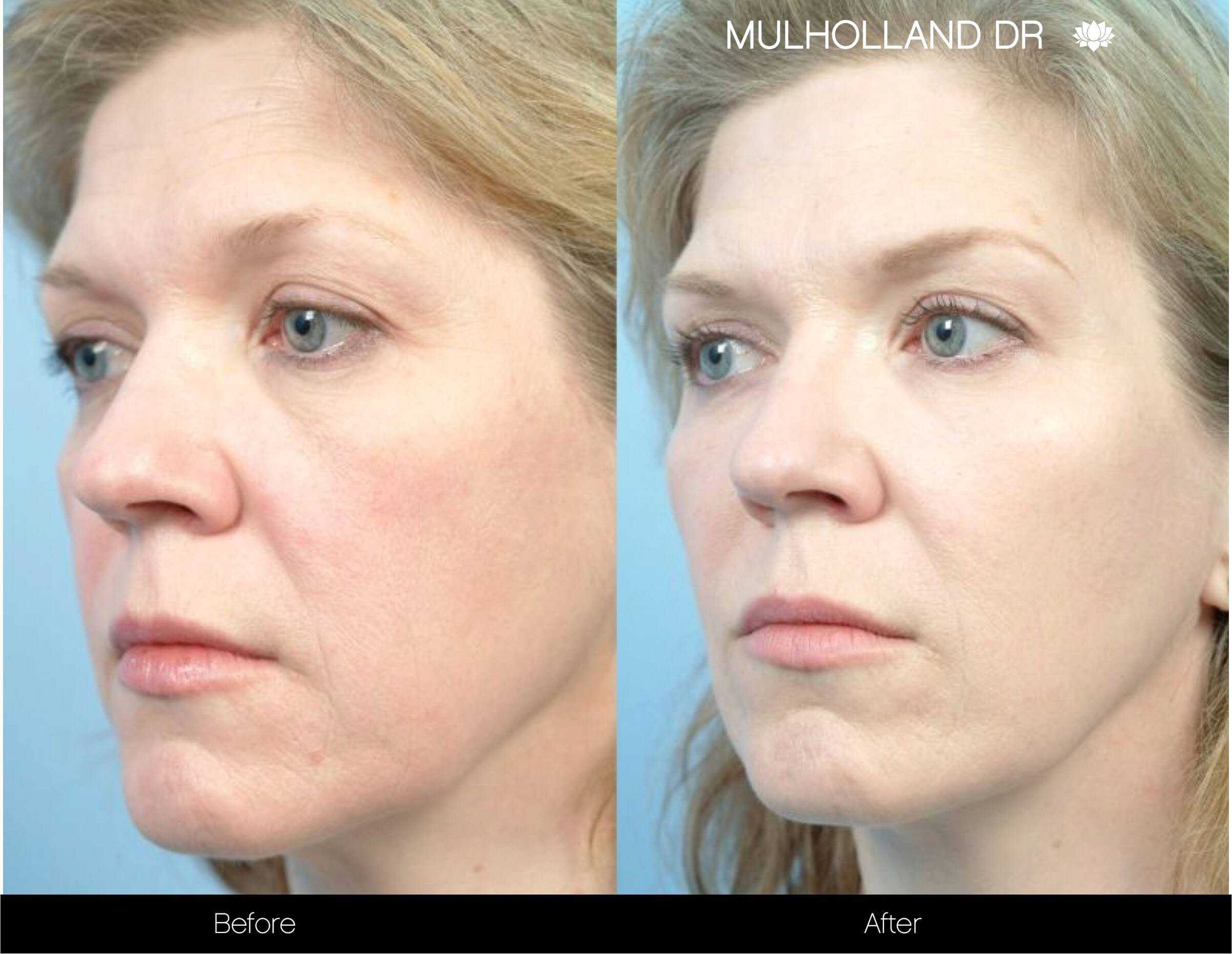 Fractional CO2 - Before and After Gallery - Patient Photo 73