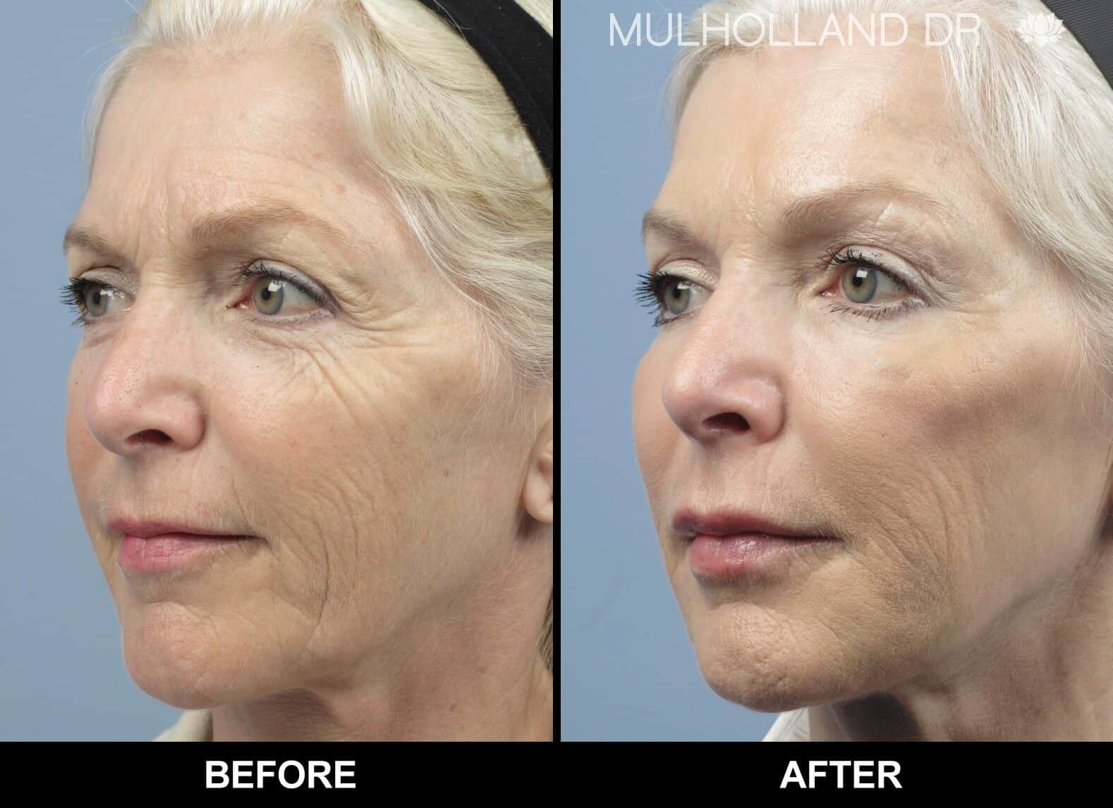 Fractional Erbium Laser - Before and After Gallery - Patient Photo 2
