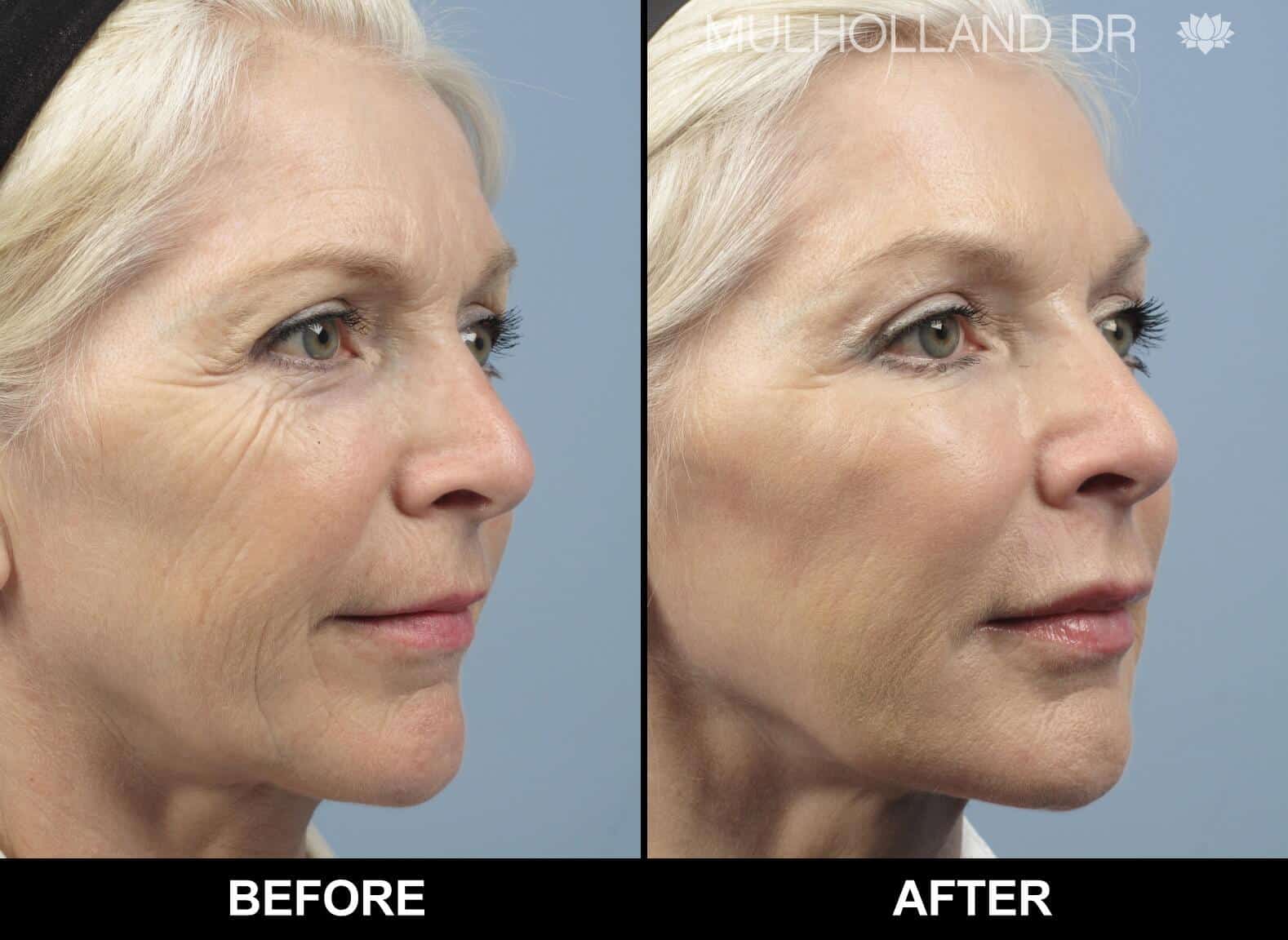 Fractional Erbium Laser - Before and After Gallery - Patient Photo 3