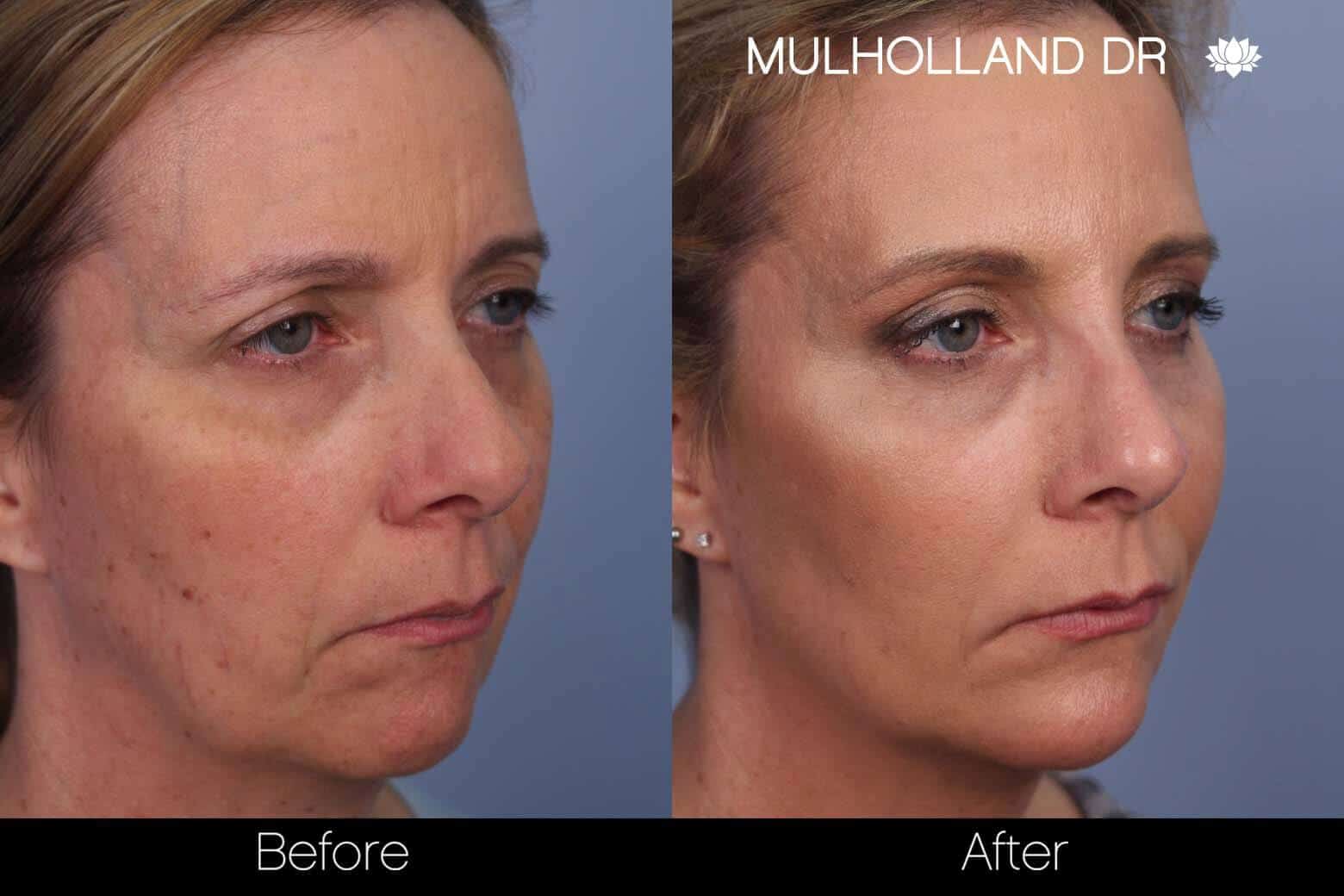 Fractional Erbium Laser - Before and After Gallery - Patient Photo 37