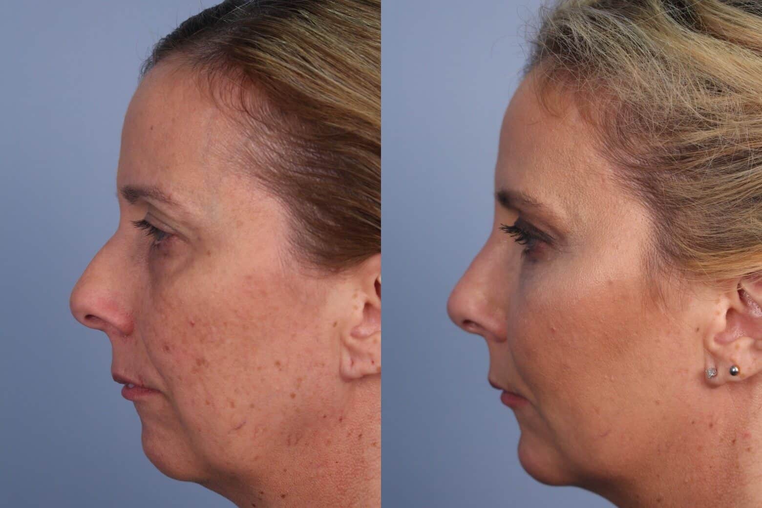 Fractional Erbium Laser - Before and After Gallery - Patient Photo 42
