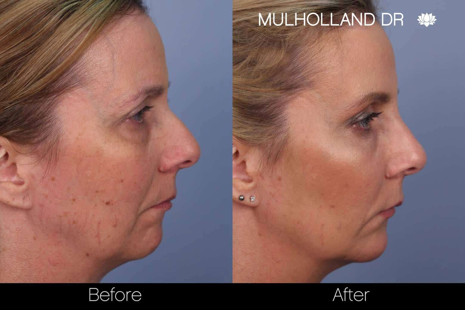 Fractional Erbium Laser - Before and After Gallery - Patient Photo 43