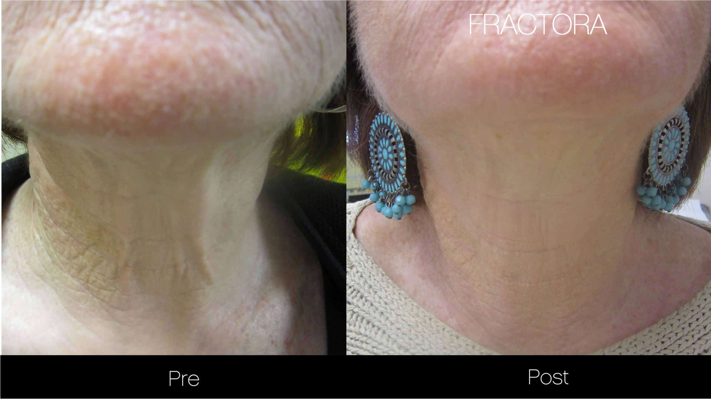 Fractora - Before and After Gallery - Patient Photo 10