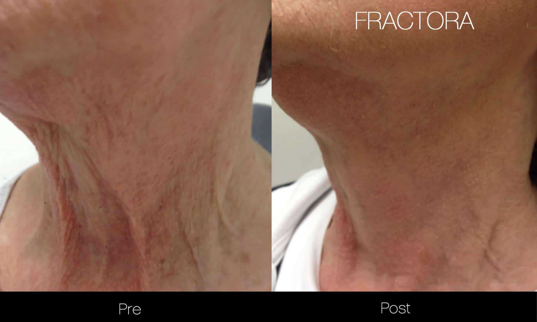 Fractora - Before and After Gallery - Patient Photo 11