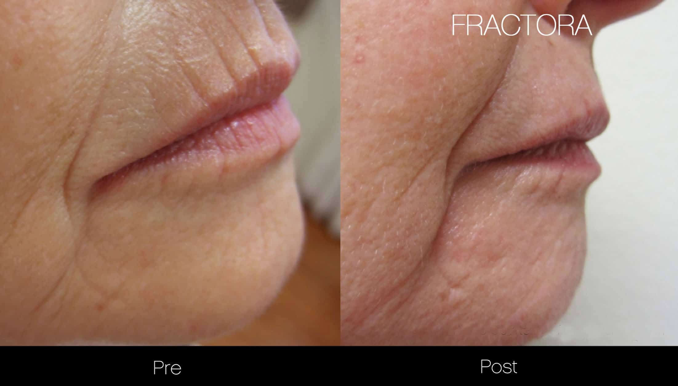 Fractora - Before and After Gallery - Patient Photo 13