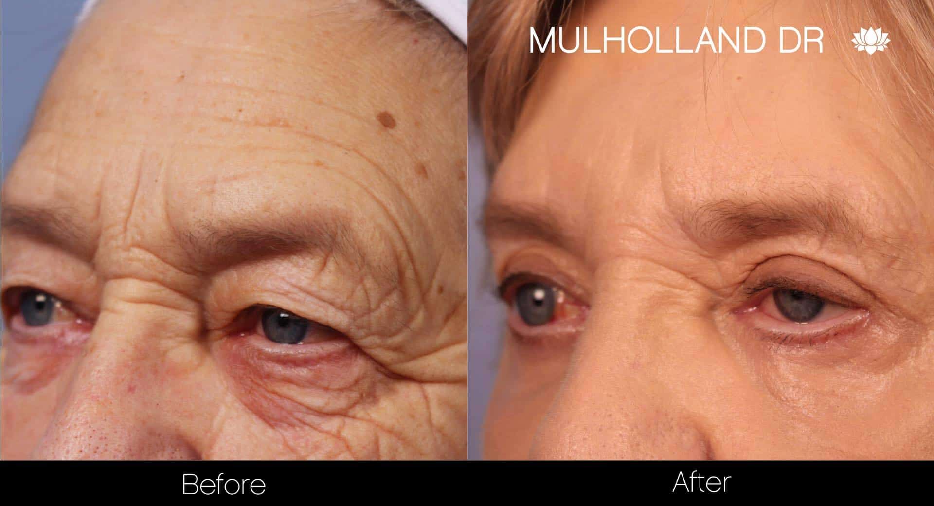 Blepharoplasty - Before and After Gallery – Photo 10