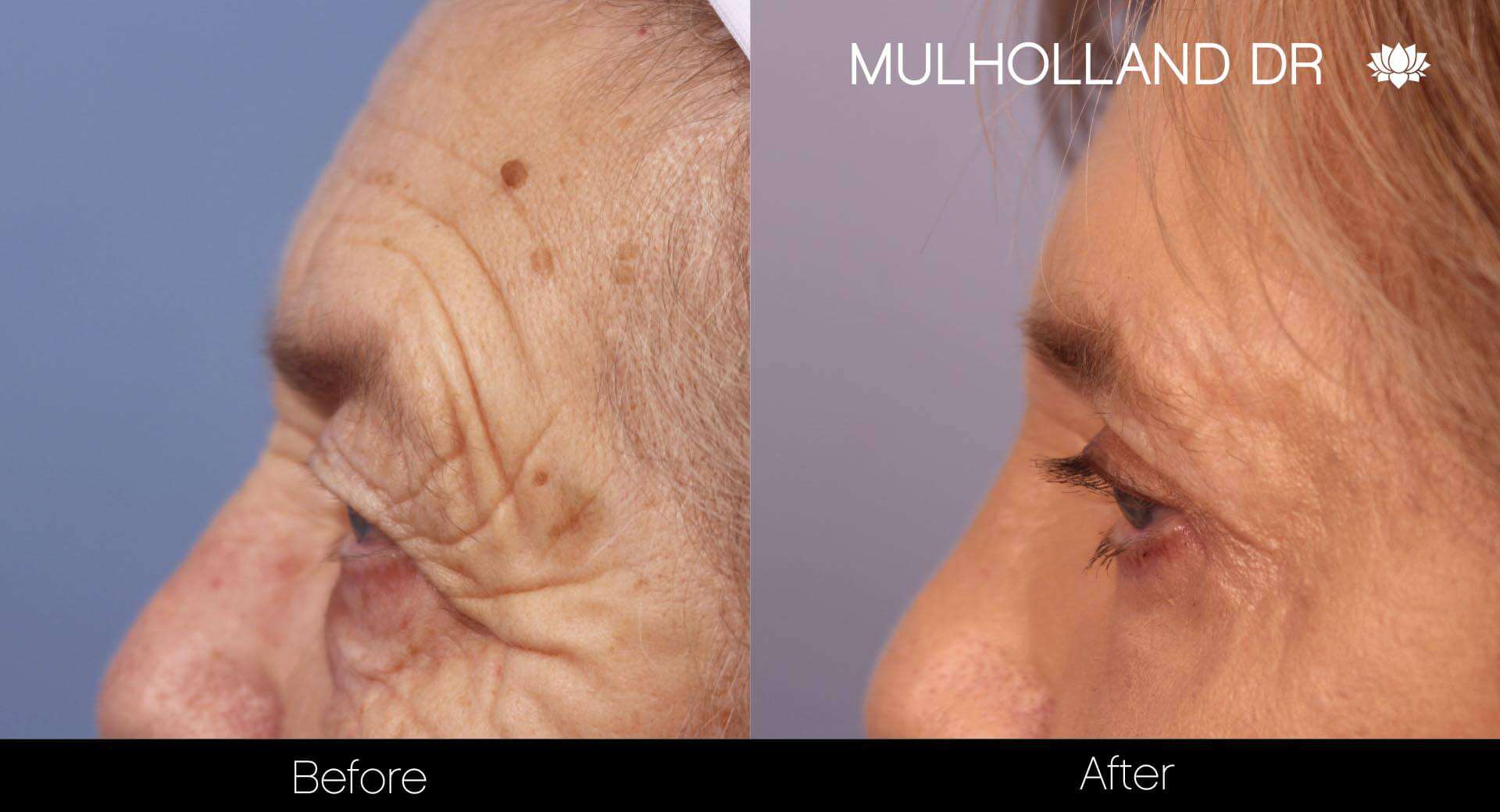 Blepharoplasty - Before and After Gallery – Photo 11