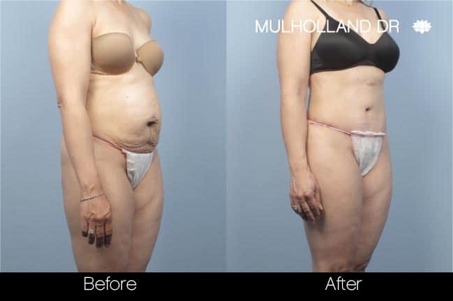 Mini Tummy Tuck Toronto - Partial Abdominoplasty