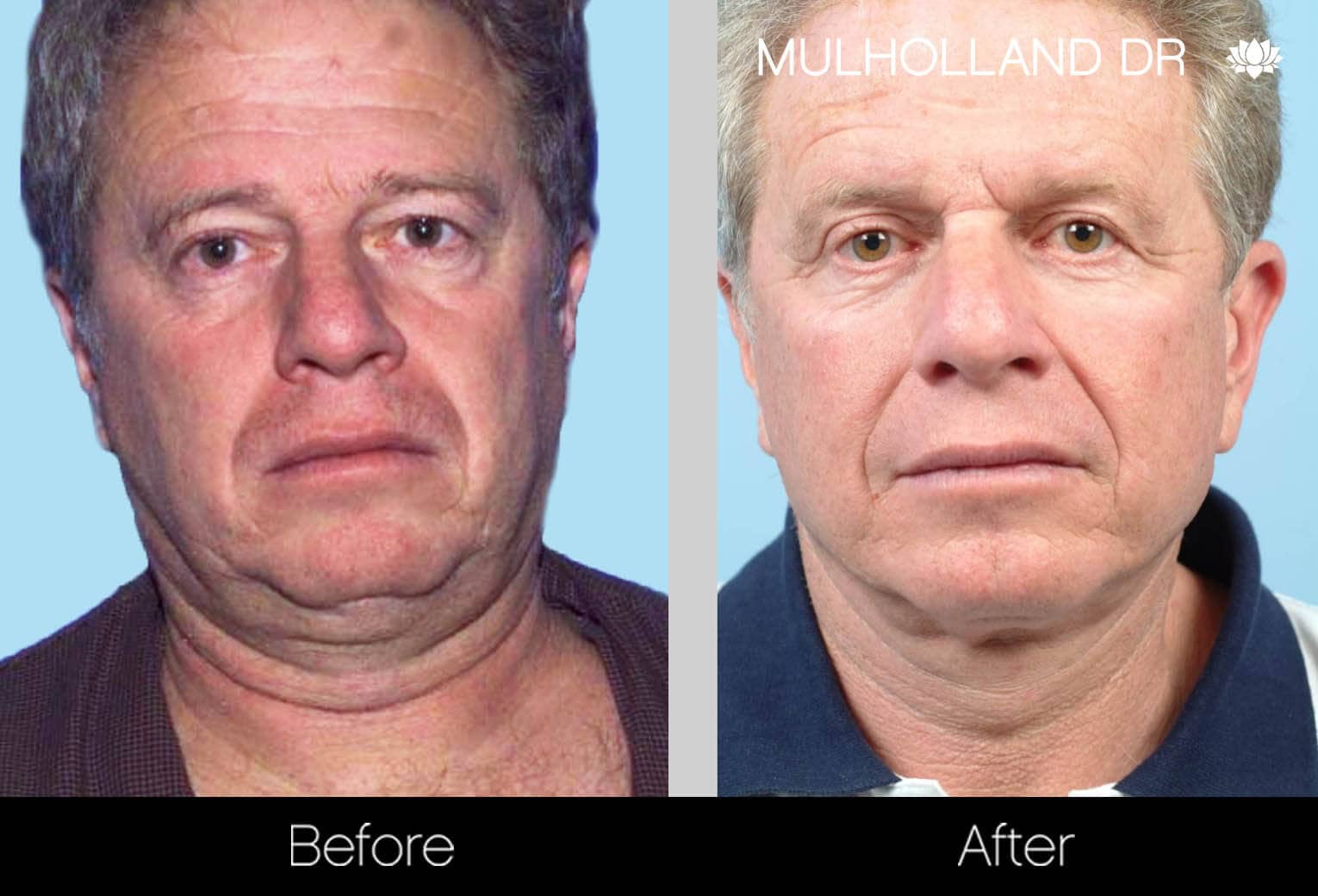 Neck Lift - Before and After Gallery - Patient Photo 126