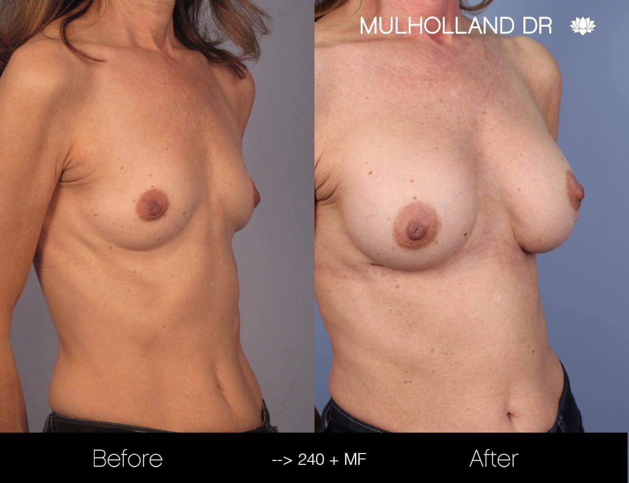 Fat Transfer Breast Augmentation - Before and After Gallery - Patient Photo 13