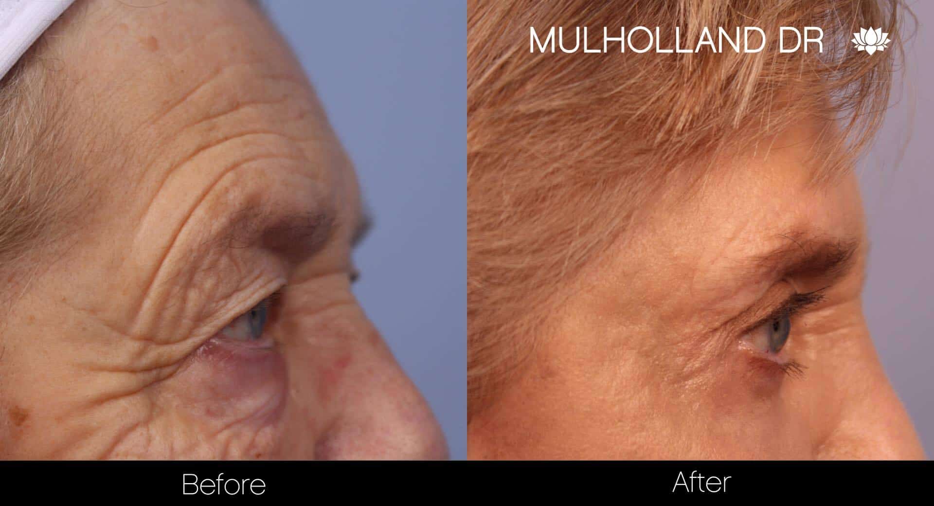 Blepharoplasty - Before and After Gallery – Photo 13