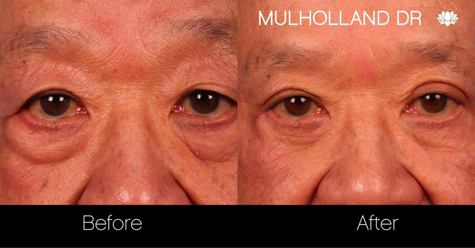 Blepharoplasty - Before and After Gallery – Photo 14
