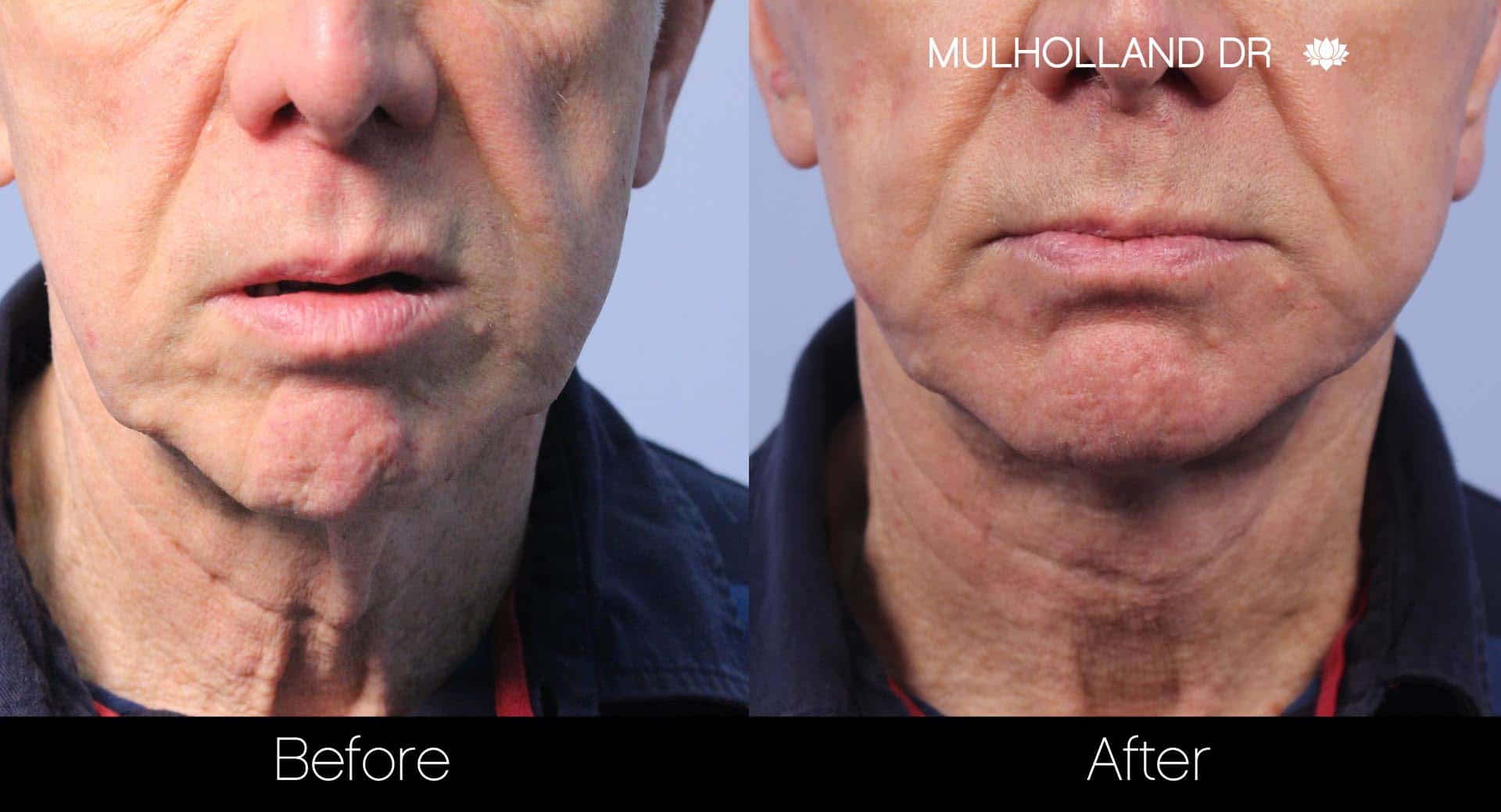 Male Double Chin - Before and After Gallery – Photo 15