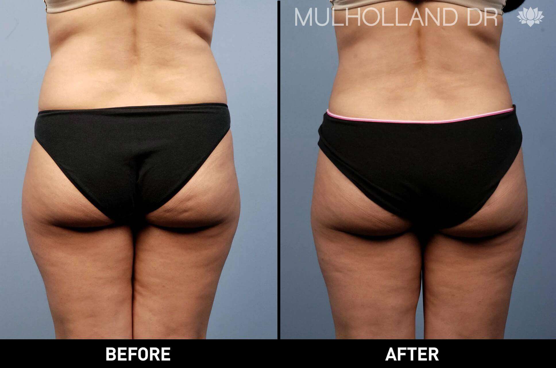BodyTite Liposuction - Before and After Gallery - Patient Photo 16